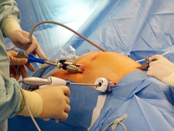 Laparoscopic and Robotic Hernia Surgery